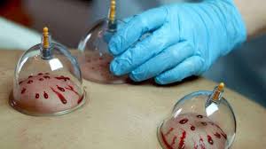 Cupping Therapy Course Image