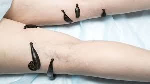 Leech Therapy Course Image